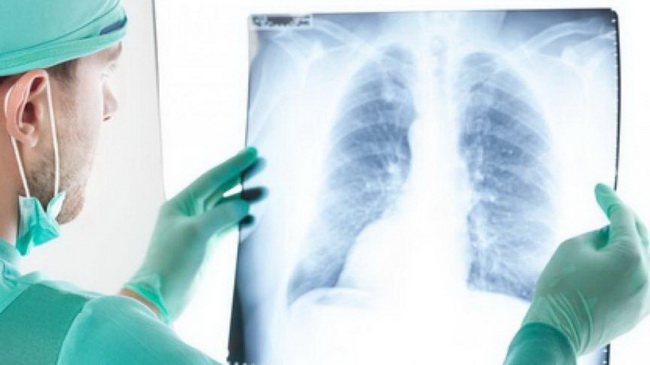 В Каменском онкобольные наиболее часто умирают от рака легких